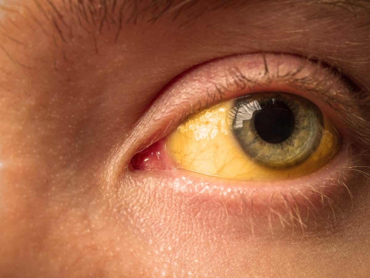 Why is the top of my eye white but the bottom a bit yellow? Is